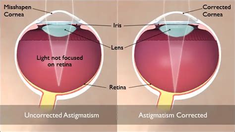 What Is Astigmatism and How to Fix It: Guides and Videos