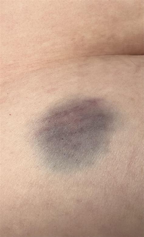 Injection site bruising : r/WegovyWeightLoss