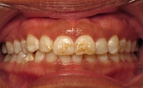 Extrinsic Teeth Stains