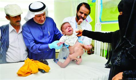 Yemeni parasitic twin to undergo surgery in KSA | Arab News