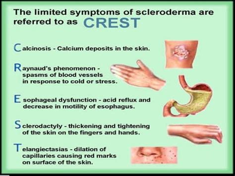 Scleroderma