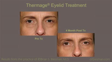 Thermage Before and After Gallery - Brian Biesman MD | Nashville, TN