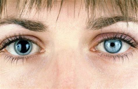 What Is Anisocoria: Causes and Treatments - Vision Center