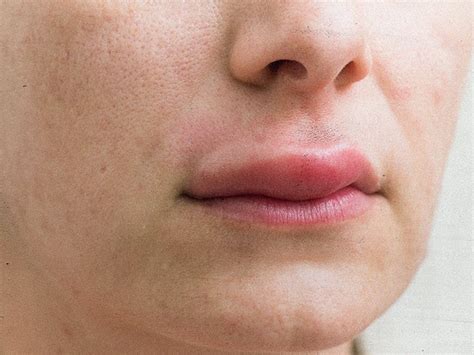 Swollen upper lip: Causes and treatments