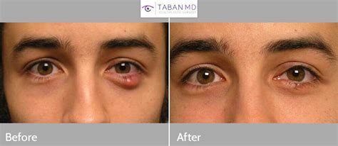 Chalazion Removal