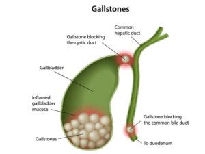 Gall bladder disease- Types, Symptoms, and Treatments