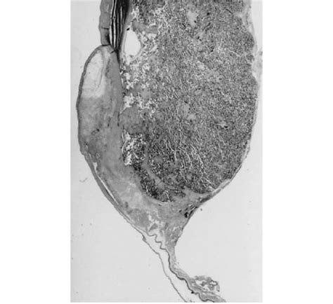 7. Margin of circumvallate placenta. The gray homogeneous material ...