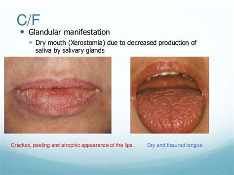 sjogren's syndrome