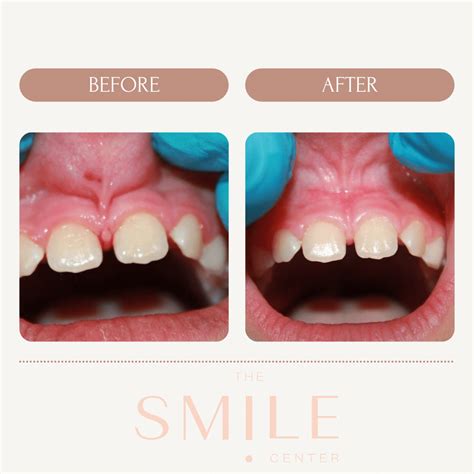 Lip & Tongue-Tie Dental Treatment | Smile Center