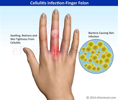 Cellulitis Infection-Finger Felon|Causes|Symptoms|Treatment-Antibiotics, I and D