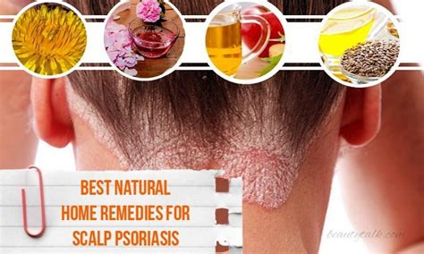 16 Best Natural Home Remedies For Scalp Psoriasis