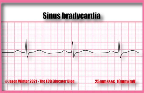 ECG Educator Blog : Sinus Bradycardia