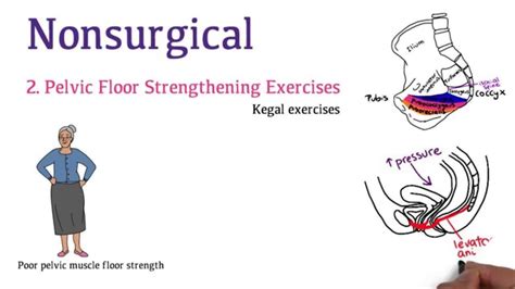 Prolapse Pelvic Floor Surgery | Viewfloor.co