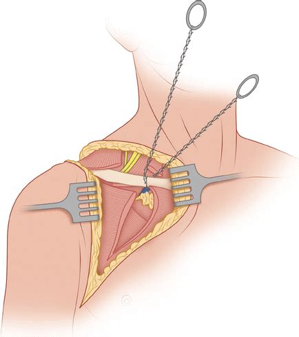 Forequarter Amputation | SpringerLink