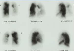 Chronic Thromboembolic Pulmonary Hypertension | CTEPH