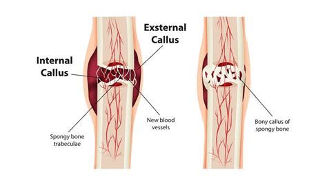 Fracture Healing Fundamentals | DePuy Synthes