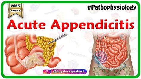 Acute appendicitis USMLE Step 1 : Etiology, Pathophysiology, Clinical ...