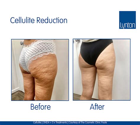 Cellulite Treatment · Cellulite Removal · The Lynton Clinic