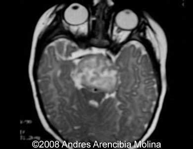 📃 Congenital hypothalamic hamartoma syndrome