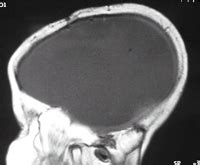 Hemispherectomy | Cleveland Clinic