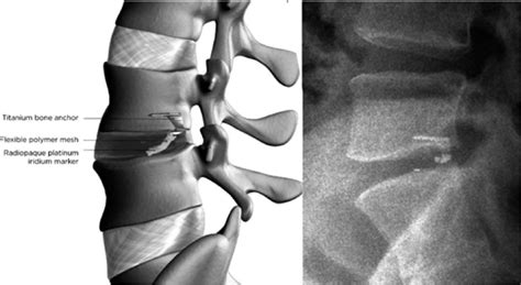 Schematic of the Barricaid Annular Closure Device (left) and lateral ...