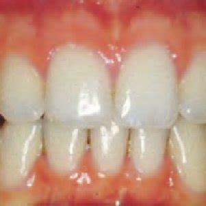 (PDF) Gingivitis Control