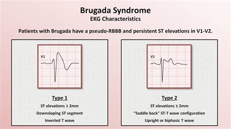 Brugada syndrome Causes, Symptoms and Treatment | Mediologiest
