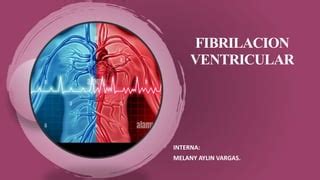 Fibrilación ventricular: causas, síntomas y tratamiento | PPT