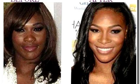 Serena Williams Before and after Plastic Surgery | Foo News