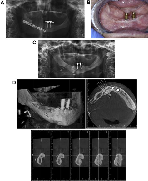 A. Immediate post-operative evaluation by orthopantomogram. B, C, D.... | Download Scientific ...