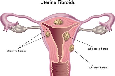 Uterine fibroids - symptoms, treatments and causes | healthdirect