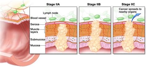 Colorectal Cancer Staging and Prognosis « CancerWORLD