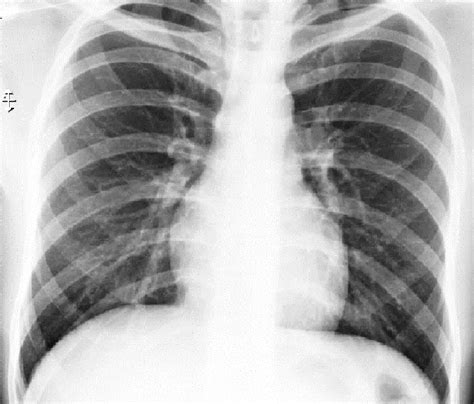 Plain X ray chest showing clear lungs (Pt. is covid 19 positive),... | Download Scientific Diagram