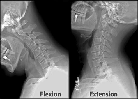 Cervical Spine Trauma Evaluation - Spine - Orthobullets