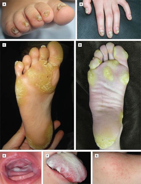 Pachyonychia Congenita in Pediatric Patients: Natural History, Features ...