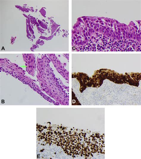 Histopathological evaluation of colposcopic biopsies, LLETZ and cold knife cone biopsies of the ...