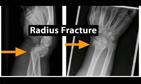 Operative treatment preferred choice for distal radius fractures: JAMA