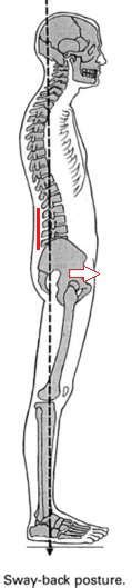 Bad posture; common examples of poor posture.