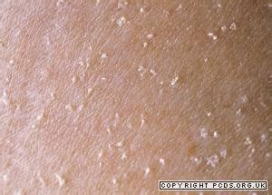 Lichen spinulosus | Primary Care Dermatology Society | UK