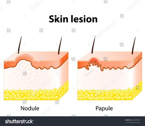 4 Papules Solid Elevations Images, Stock Photos & Vectors | Shutterstock