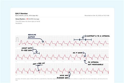 Accelerated Idioventricular Rhythm Vs. Premature Ventricular ...