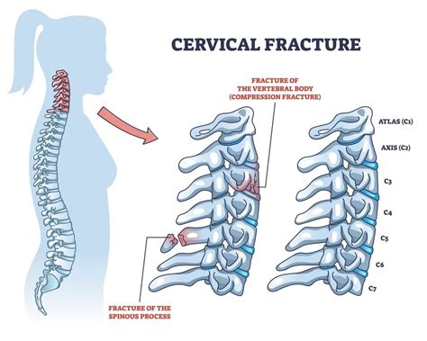 Cervical Fractures: Types, Symptoms, Causes & Treatment - Zealmax ...