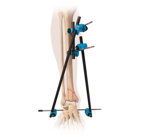 Leg Injury Treatment Tibial Fracture External Fixation