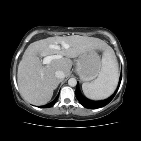 An unusual differential diagnosis of a left iliac fossa mass | BMJ Case ...