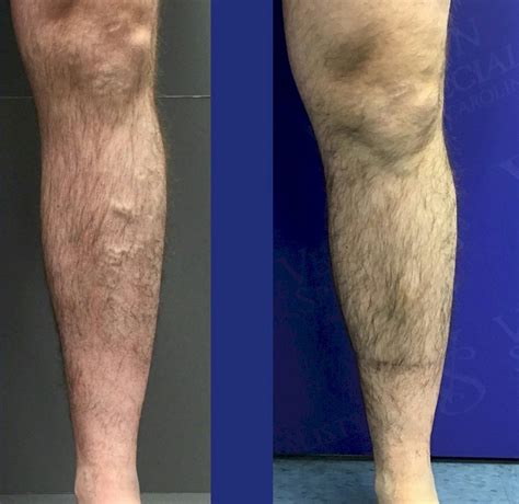 Before and After Vein Treatment Photos - Vein Specialists of the Carolinas