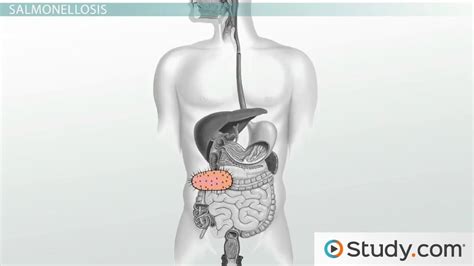 Salmonella Poisoning | Symptoms, Diagnosis & Treatment - Lesson | Study.com