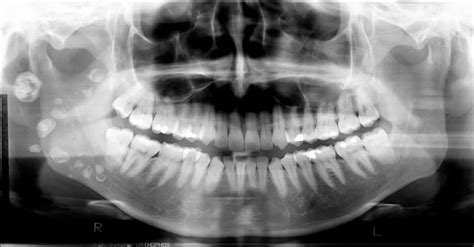 Panoramic Radiograph Anatomy - Anatomical Charts & Posters