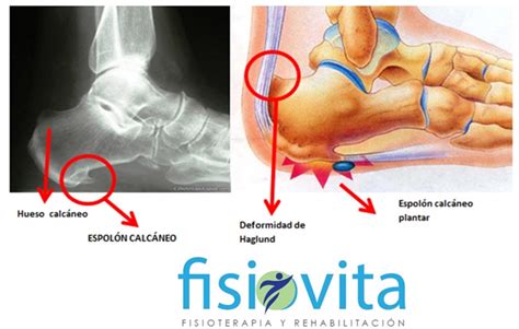 ESPOLÓN CALCÁNEO. CAUSAS, SÍNTOMAS Y TRATAMIENTO.