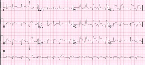 Dr. Smith's ECG Blog: Subacute AnteroSeptal STEMI, With Persistent ST ...