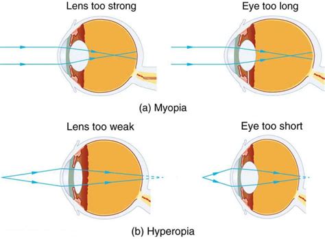 Vision Correction | Physics